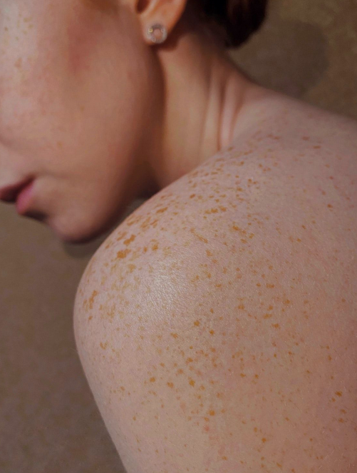 How to Treat Hyperpigmentation with Dr. Trang Vo-Nguyen