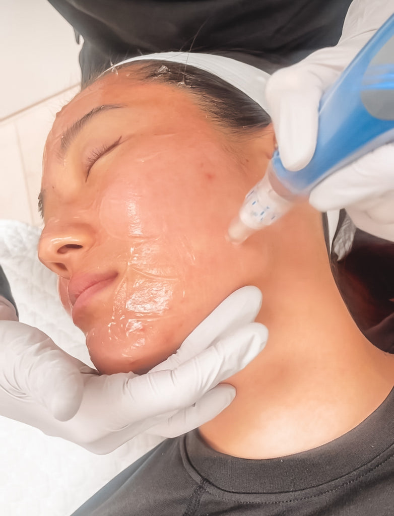Restore Your Collagen With Microneedling
